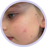 Blemishes and Breakouts