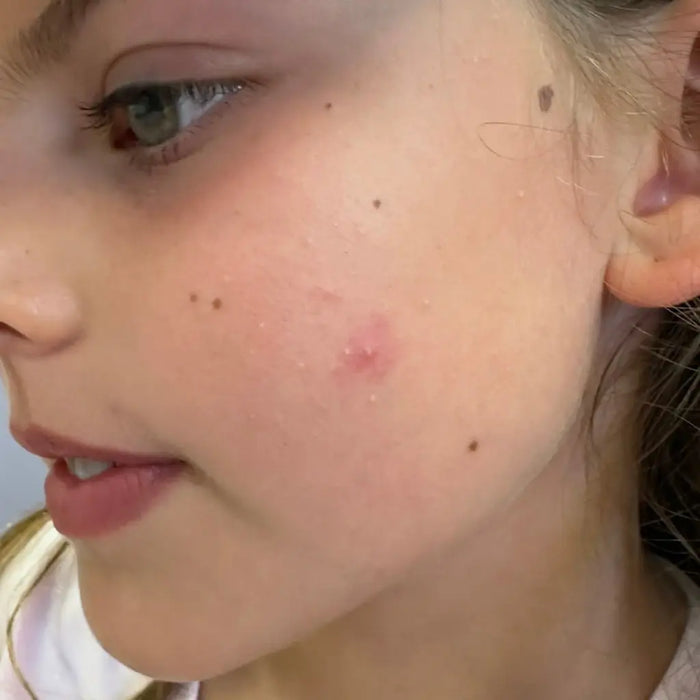 Blackheads + Congestion