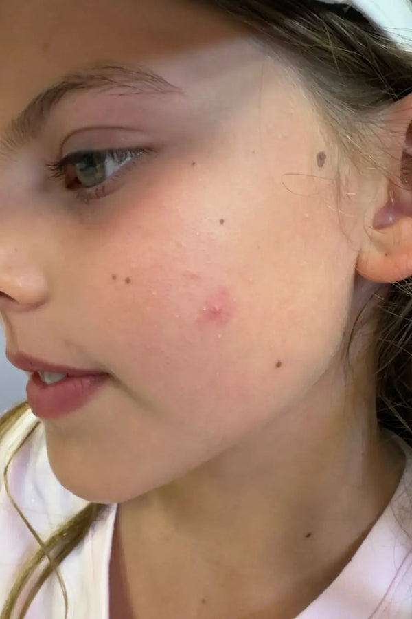 Close-up of a young girl’s cheek with a small red blemish, highlighting natural skin with gentle skincare needs for children aged 7 to 14, good skin habits start early.