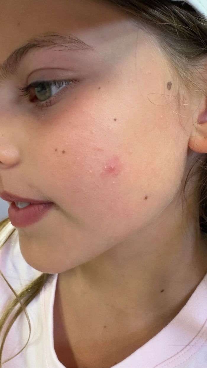 Breakouts & Blackheads