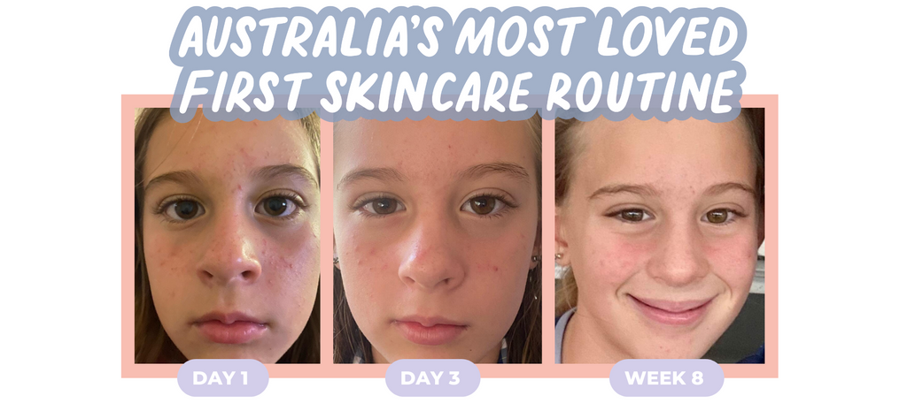 pre-teen-skincare-results-petite-skin-co